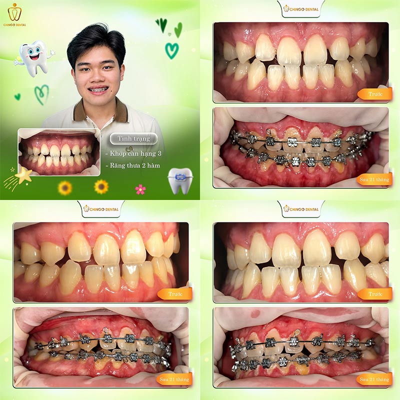 Niềng Răng Móm Trước Và Sau: Hình Ảnh Thực Tế & Quy Trình Đầy Đủ 4 hình ảnh trước và sau niềng răng