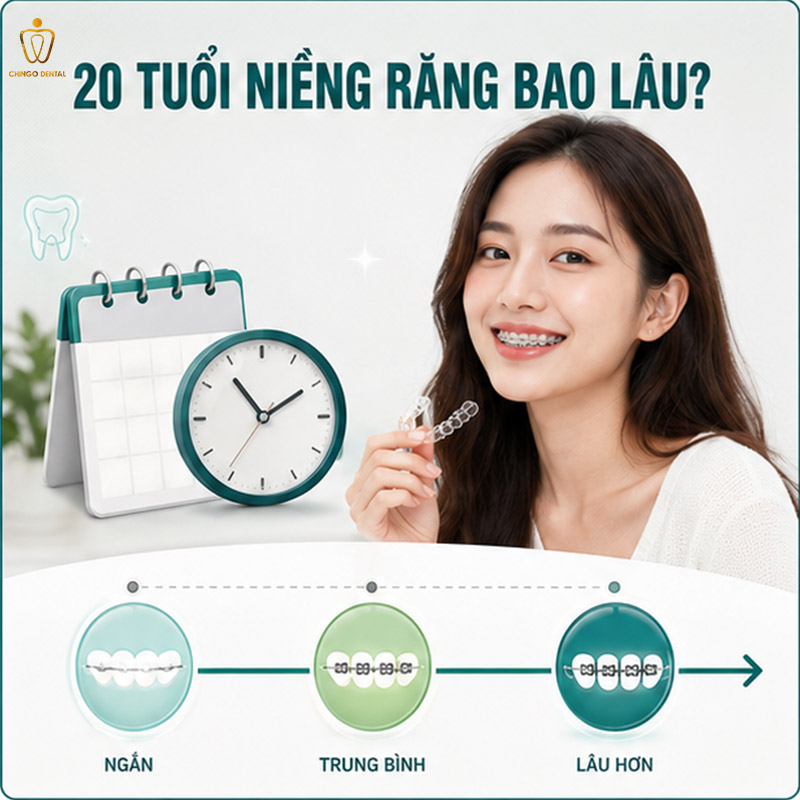 20 Tuổi Niềng Răng Bao Nhiêu Tiền? Bảng Giá & Giải Đáp Toàn Diện 4 niềng răng bao nhiêu năm