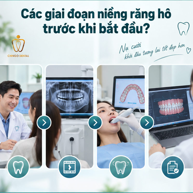 Các Giai Đoạn Niềng Răng Hô: Lộ Trình Chi Tiết Từng Bước Bạn Cần Biết 2 nieng rang ho