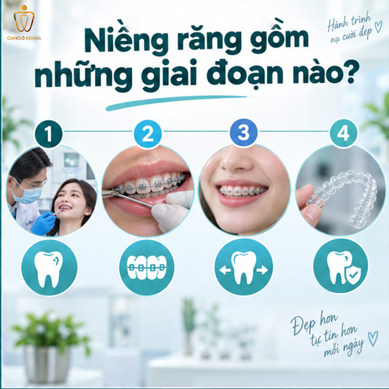 Các Giai Đoạn Đóng Khoảng Trong Niềng Răng: Mất Bao Lâu Và Điều Gì Xảy Ra? 2 niềng răng mất bao lâu