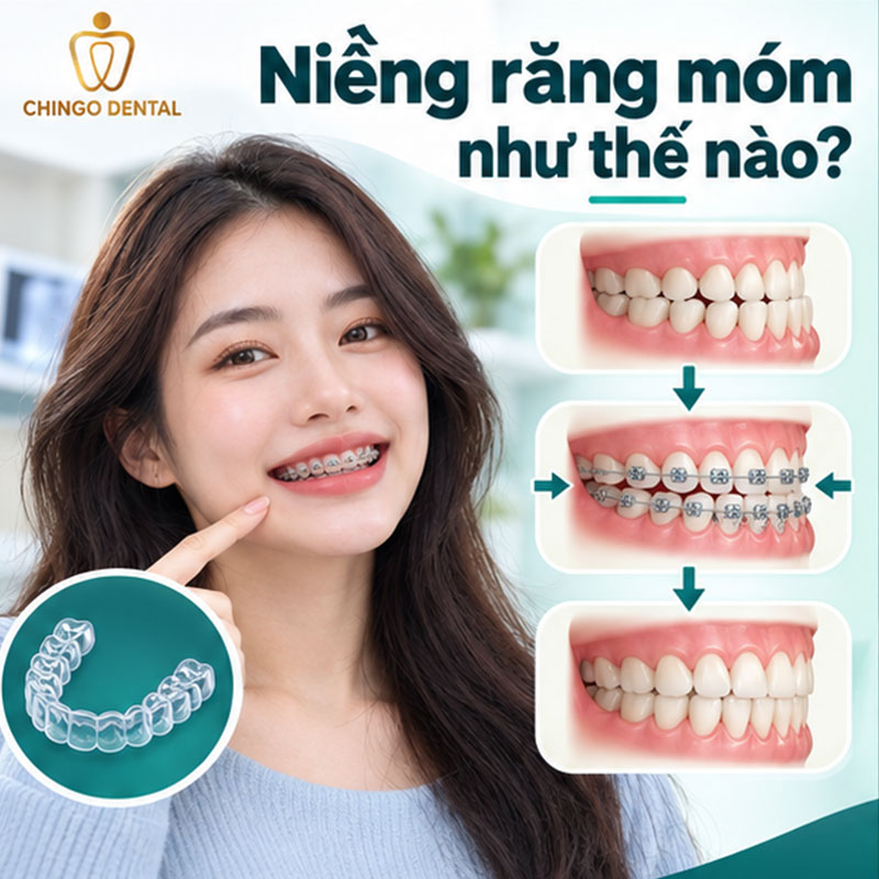 Niềng Răng Móm Trước Và Sau: Hình Ảnh Thực Tế & Quy Trình Đầy Đủ 6 niềng răng móm như thế nào
