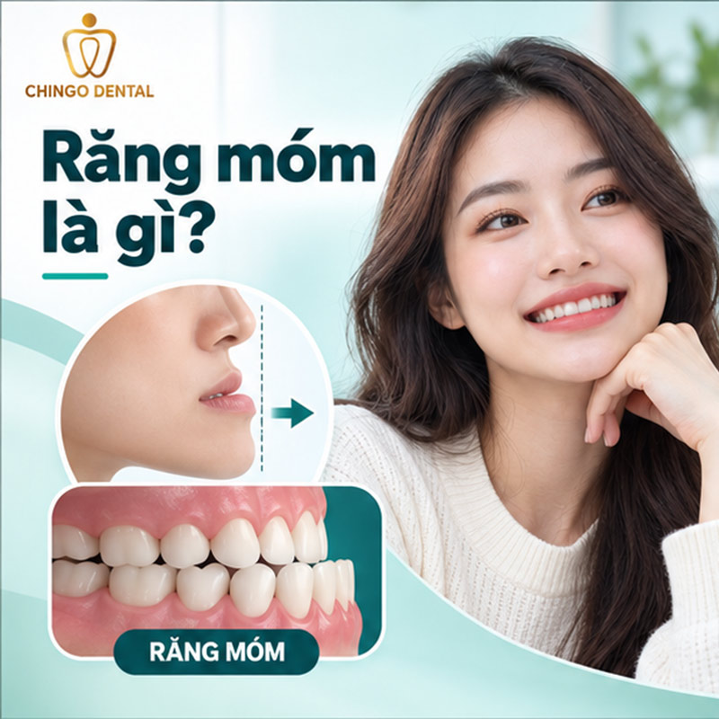 Niềng Răng Móm Trước Và Sau: Hình Ảnh Thực Tế & Quy Trình Đầy Đủ 1 niềng răng móm trước và sau