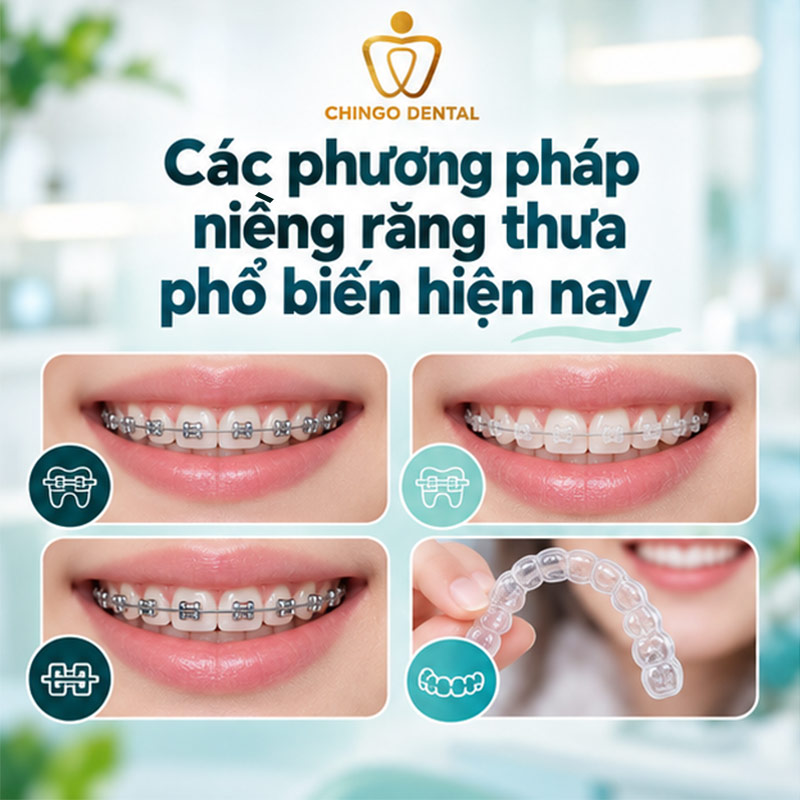 Thời Gian Niềng Răng Thưa Bao Lâu? Quy Trình, Chi Phí & Những Điều Cần Biết 3 niềng răng thưa bao nhiêu tiền