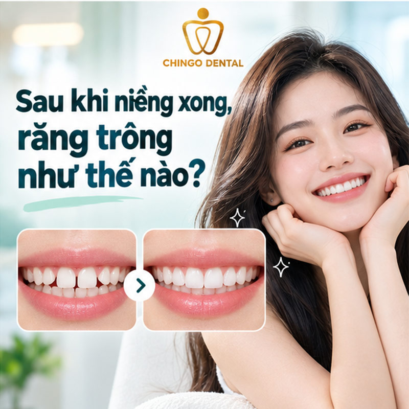 Thời Gian Niềng Răng Thưa Bao Lâu? Quy Trình, Chi Phí & Những Điều Cần Biết 4 niềng răng thưa mất bao lâu