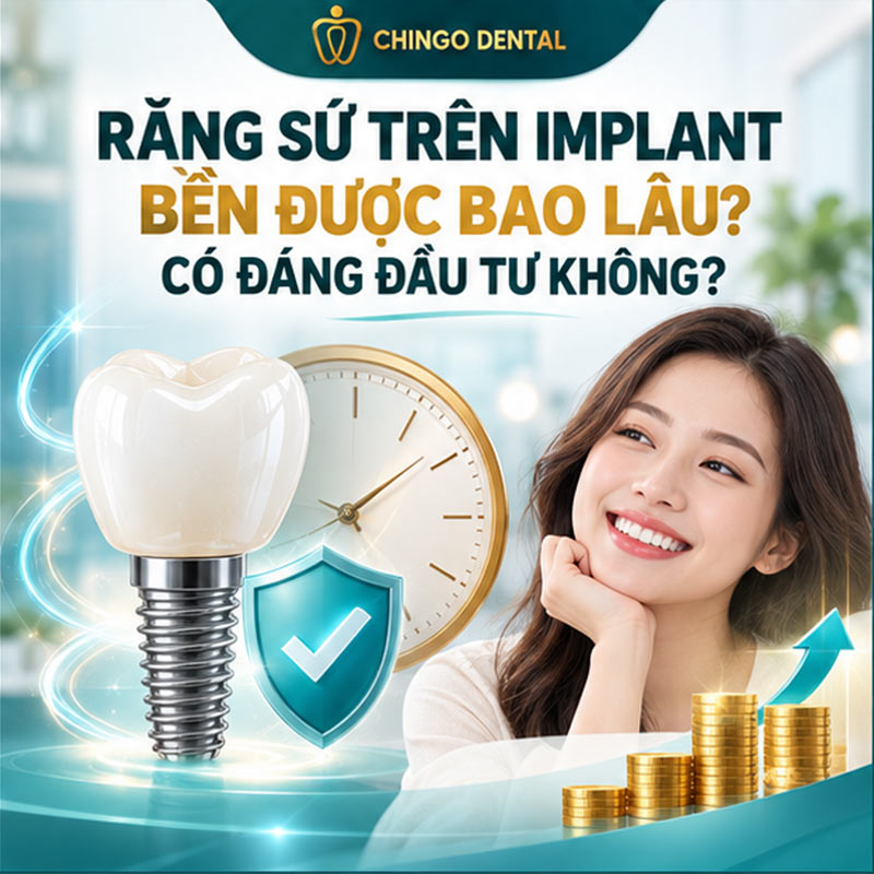 Răng Sứ Trên Implant: Giải Pháp Phục Hình Mất Răng Bền Vững Nhất Hiện Nay 4 phục hình răng sứ