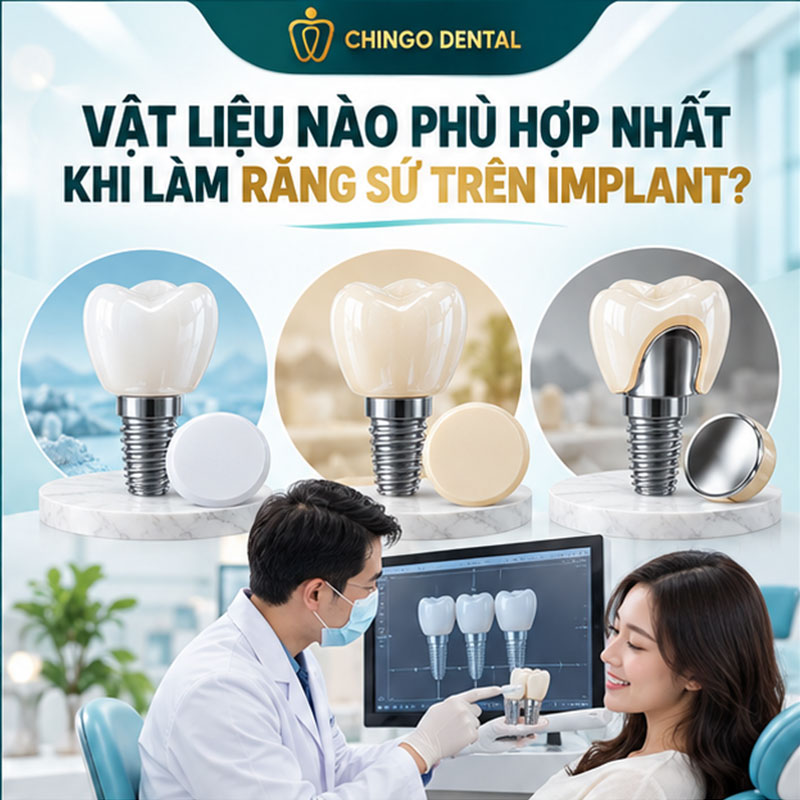 Răng Sứ Trên Implant: Giải Pháp Phục Hình Mất Răng Bền Vững Nhất Hiện Nay 2 răng sứ implant
