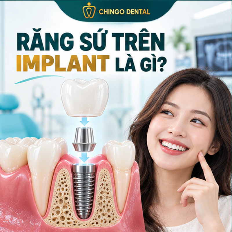 Răng Sứ Trên Implant: Giải Pháp Phục Hình Mất Răng Bền Vững Nhất Hiện Nay 1 răng sứ trên implant