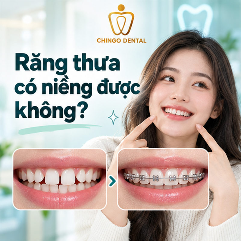 Thời Gian Niềng Răng Thưa Bao Lâu? Quy Trình, Chi Phí & Những Điều Cần Biết 1 thời gian niềng răng thưa