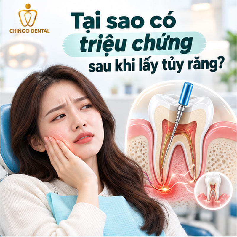 Triệu Chứng Sau Khi Lấy Tủy Răng: Bình Thường Hay Đáng Lo? Cách Xử Lý Đúng Ngay Tại Nhà 1 triệu chứng sau khi lấy tuỷ răng