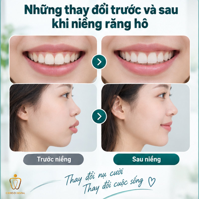 Các Giai Đoạn Niềng Răng Hô: Lộ Trình Chi Tiết Từng Bước Bạn Cần Biết 3 trước và sau khi niềng răng hô