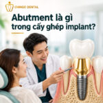 Abutment Là Gì? Tất Cả Những Điều Bạn Cần Biết Về Trụ Kết Nối Implant abutment là gì