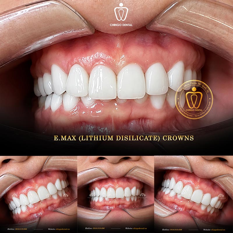Porcelain Crowns: The Complete Patient Guide (Types, Materials & What to Expect) 3 best crown for molars