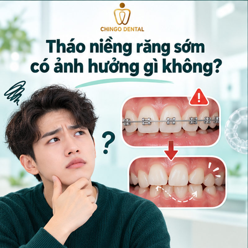 Tháo Niềng Răng – Những Điều Bạn Cần Biết Trước Khi Kết Thúc Hành Trình 3 bỏ niềng răng giữa chừng