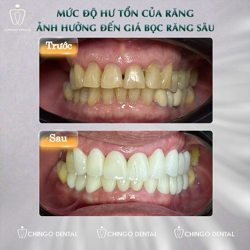 Bọc Răng Sâu: Điều Kiện, Quy Trình Từng Bước Và Chi Phí Thực Tế 5 bọc răng sâu giá bao nhiêu