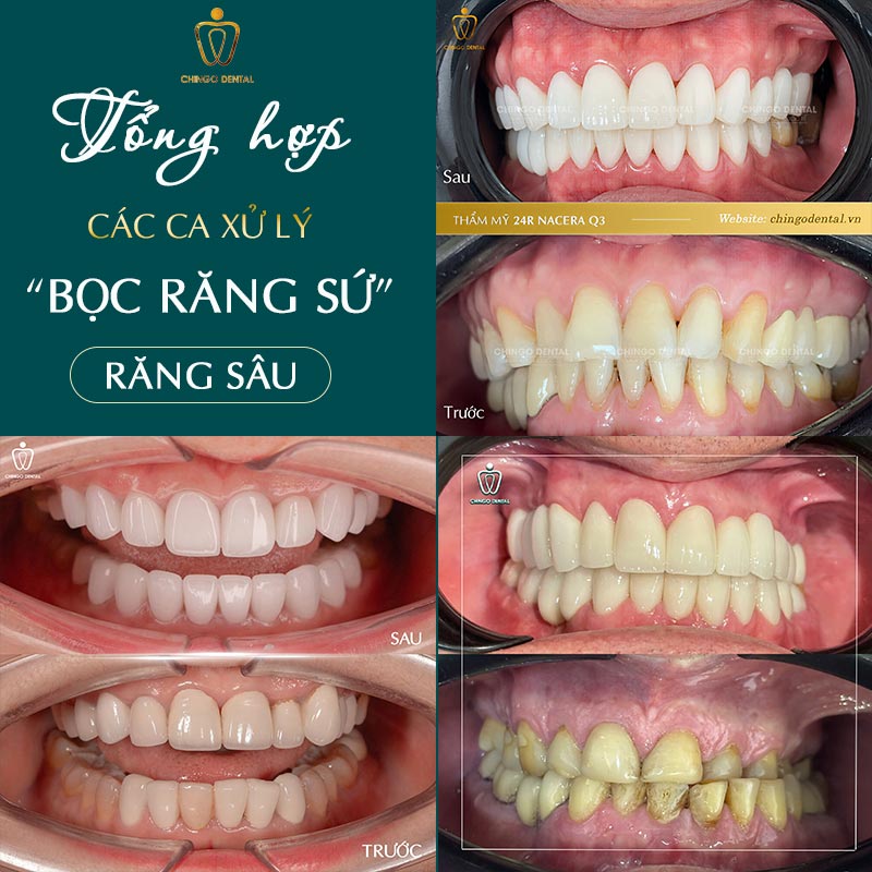 Bọc Răng Sâu: Điều Kiện, Quy Trình Từng Bước Và Chi Phí Thực Tế 6 bọc răng sâu