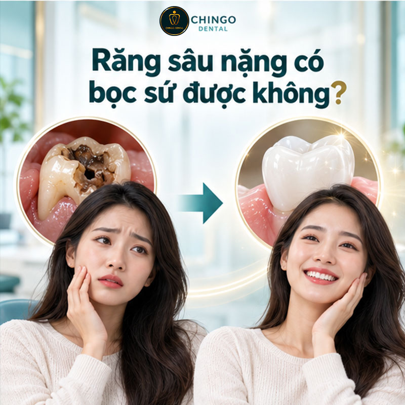Bọc Răng Sâu: Điều Kiện, Quy Trình Từng Bước Và Chi Phí Thực Tế 3 bọc răng sứ cho răng sâu
