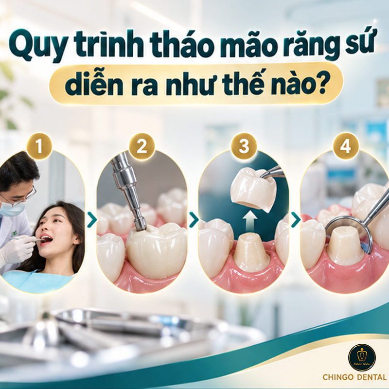 Bọc Răng Sứ Có Tháo Ra Được Không? Bác Sĩ Giải Đáp Toàn Diện 2 bọc răng sứ có bị rơi ra không