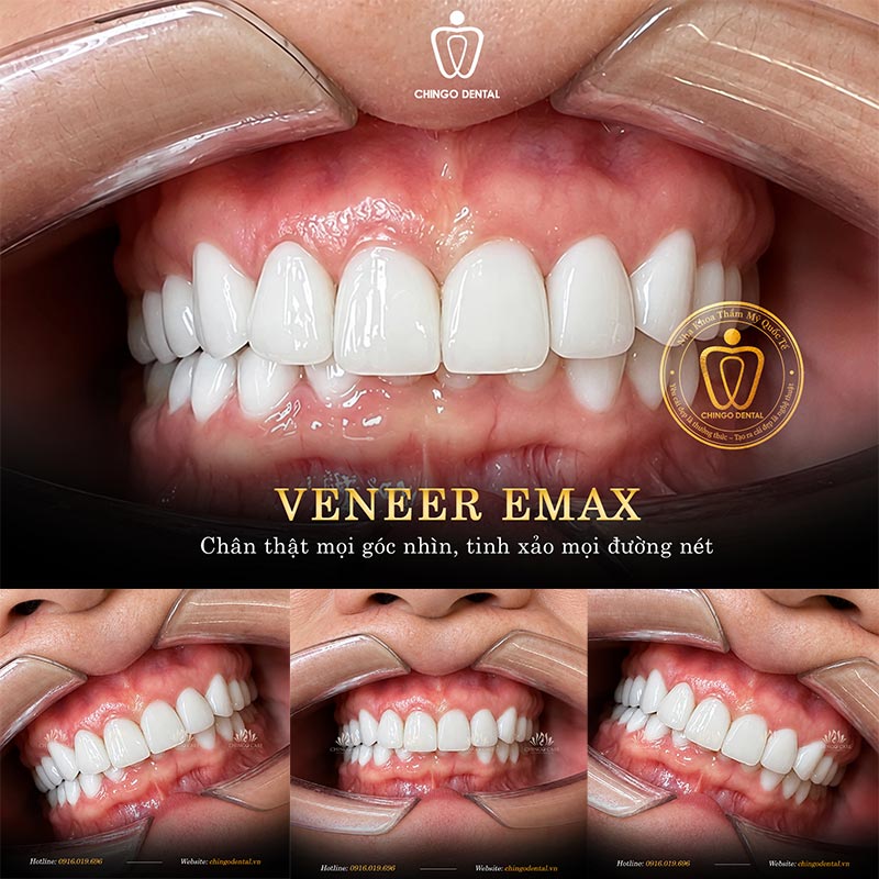 Các Loại Răng Sứ Hiện Nay: Phân Loại, So Sánh và Cách Chọn Đúng Nhất 3 các loại răng sứ