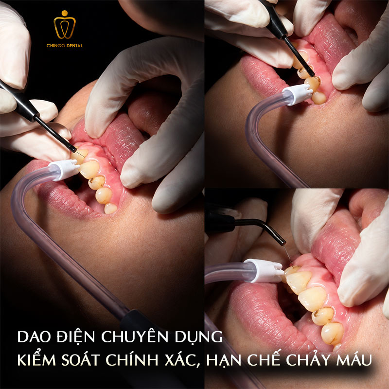 Cắt Lợi Có Đau Không? Giải Đáp Từ A - Z Cho Người Lần Đầu Thực Hiện 5 cắt lợi bao nhiêu tiền