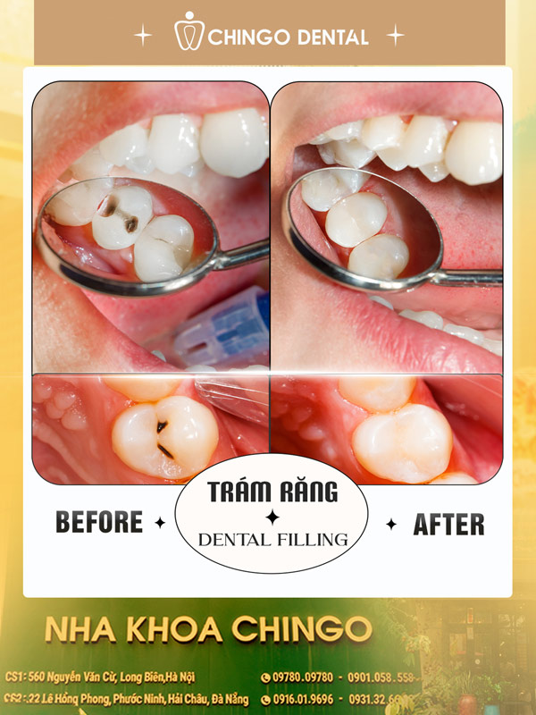 Tooth Decay (Cavities): Causes, Stages, Symptoms & Treatment 6 cavity
