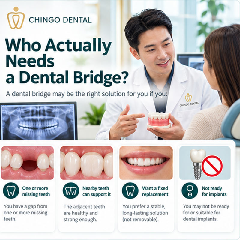Dental Bridge: Your Complete Guide to Replacing Missing Teeth 2 ceramic bridge