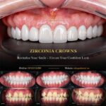 Porcelain Crowns: The Complete Patient Guide (Types, Materials & What to Expect) dental crown material