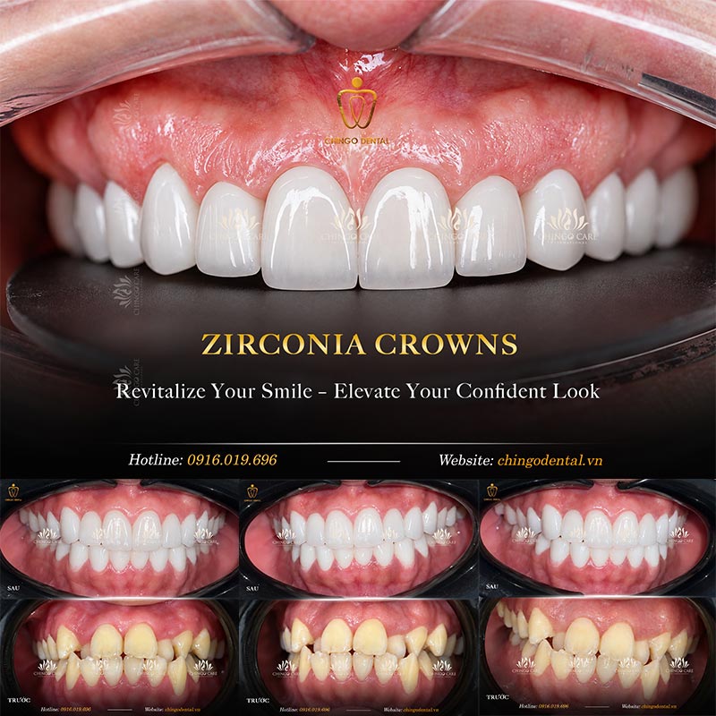 Porcelain Crowns: The Complete Patient Guide (Types, Materials & What to Expect) 5 dental crown material