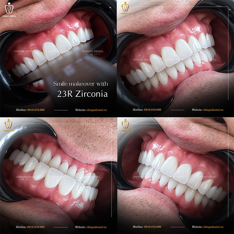 Porcelain Crowns: The Complete Patient Guide (Types, Materials & What to Expect) 2 dental implant crown