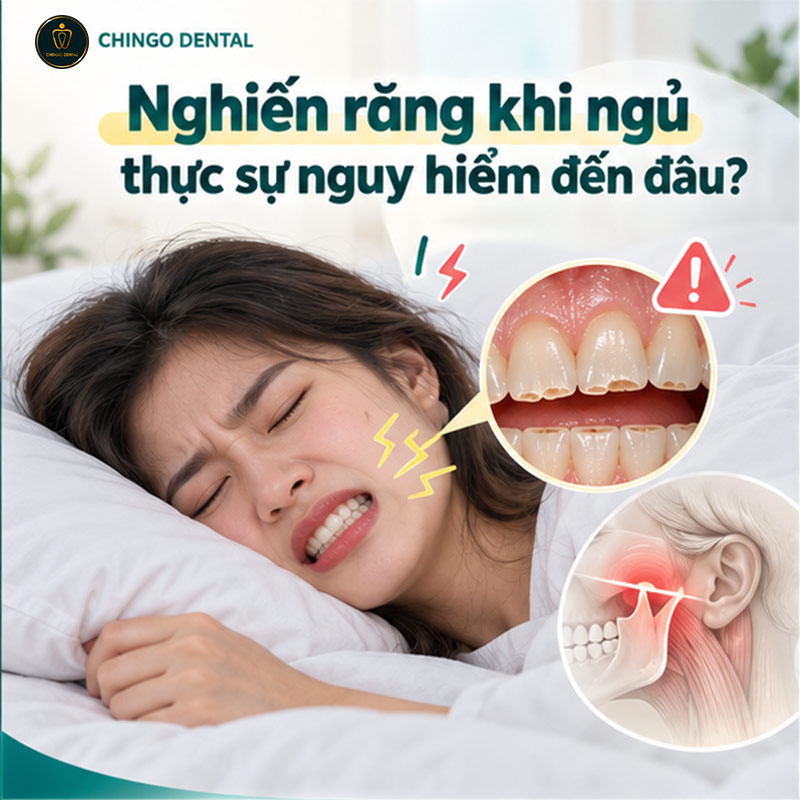 Dụng Cụ Chống Nghiến Răng: Phân Loại, Hiệu Quả và Hướng Dẫn Lựa Chọn Đúng 1 dụng cụ chống nghiến răng