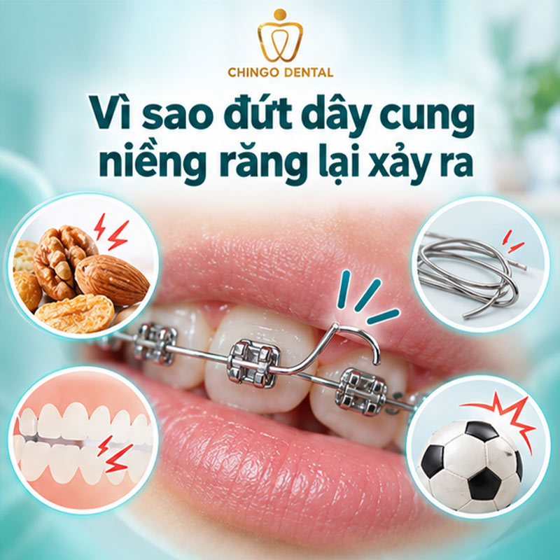 Đứt Dây Cung Niềng Răng: Nguyên Nhân, Cách Xử Lý Tạm Thời & Khi Nào Cần Gặp Bác Sĩ Ngay 2 đứt dây cung niềng răng