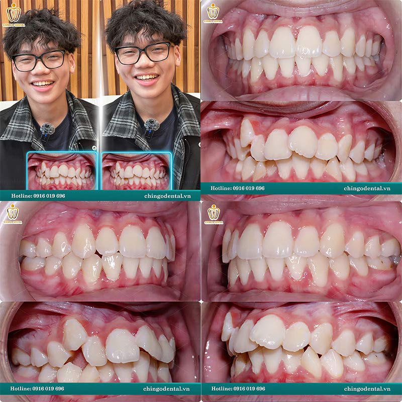 Quá Trình Thay Đổi Khi Niềng Răng: Hành Trình Từ Trước Và Sau Mà Bạn Cần Biết 6 hình ảnh niềng răng