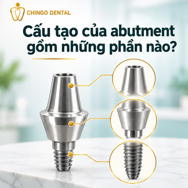 Abutment Là Gì? Tất Cả Những Điều Bạn Cần Biết Về Trụ Kết Nối Implant 2 implant abutment