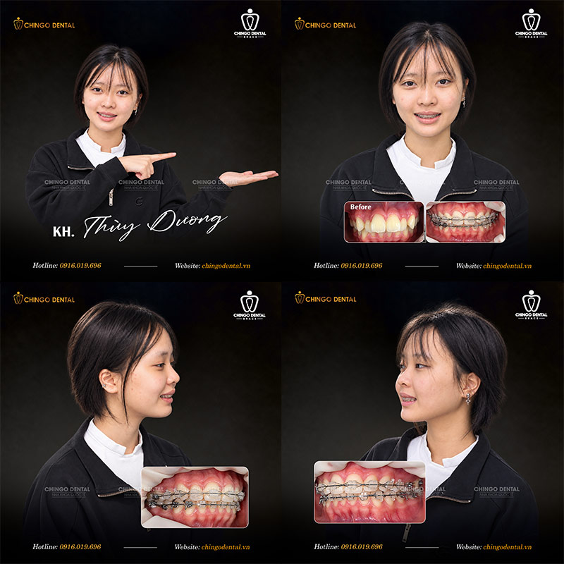 Quá Trình Thay Đổi Khi Niềng Răng: Hành Trình Từ Trước Và Sau Mà Bạn Cần Biết 7 khuôn mặt trước và sau khi niềng răng