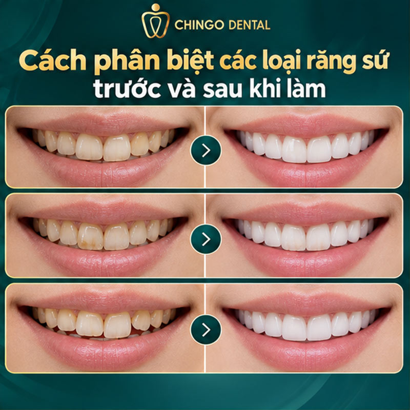 Các Loại Răng Sứ Hiện Nay: Phân Loại, So Sánh và Cách Chọn Đúng Nhất 6 làm răng sứ thẩm mỹ loại nào đẹp nhất
