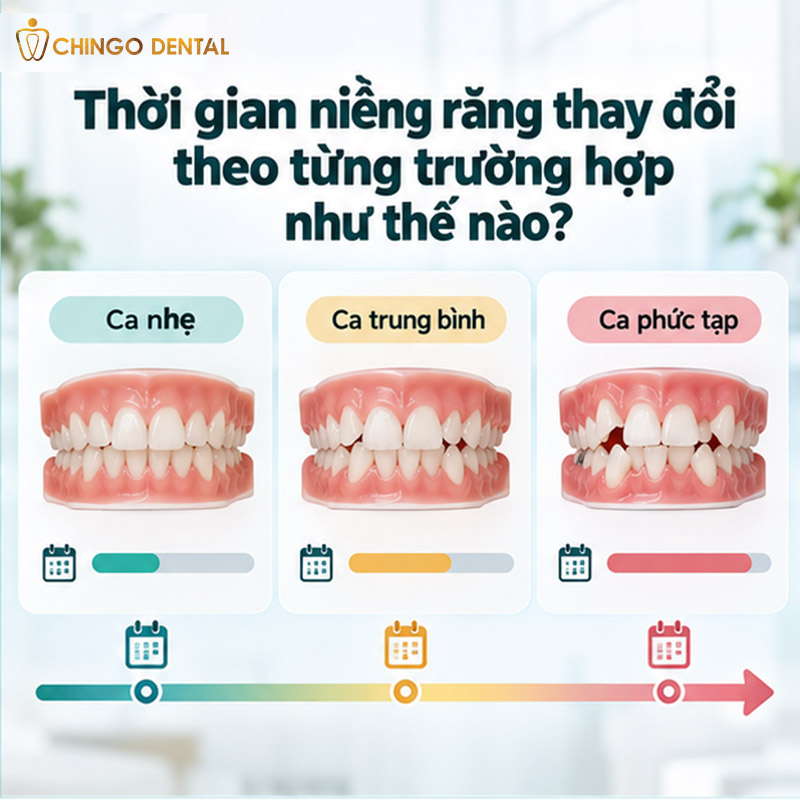 Niềng Răng Nhanh Mất Bao Lâu? Lộ Trình Thực Tế Từ Gắn Mắc Cài Đến Ngày Tháo Niềng 2 niềng răng 1 hàm mất bao lâu