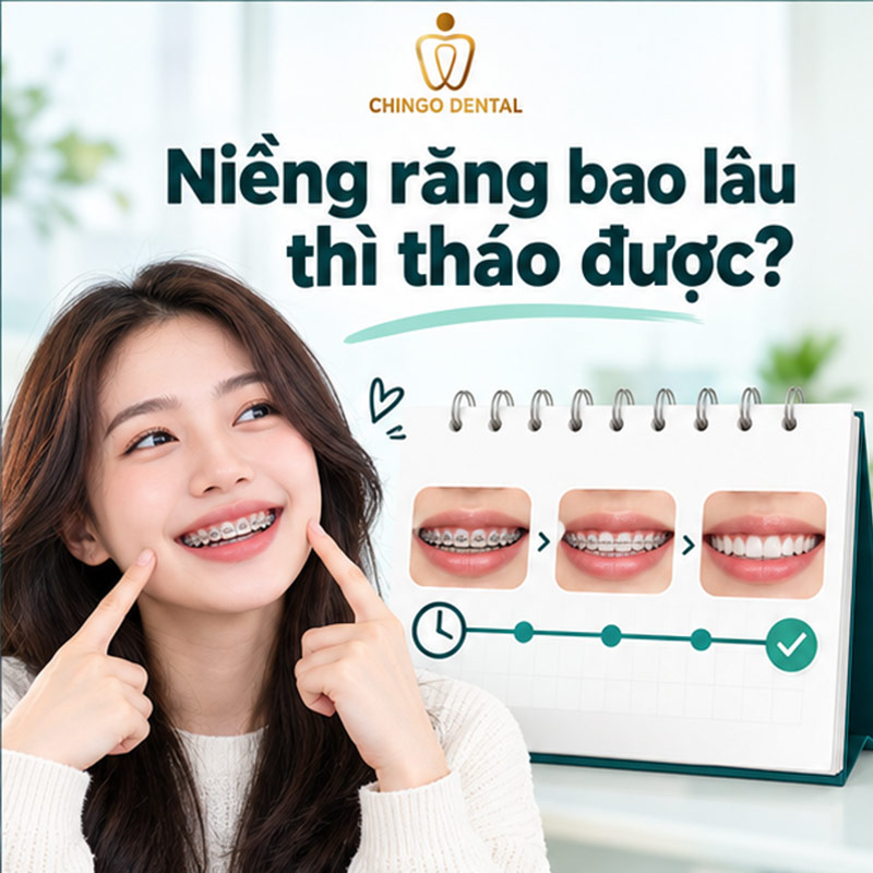 Tháo Niềng Răng – Những Điều Bạn Cần Biết Trước Khi Kết Thúc Hành Trình 1 niềng răng bao lâu thì tháo