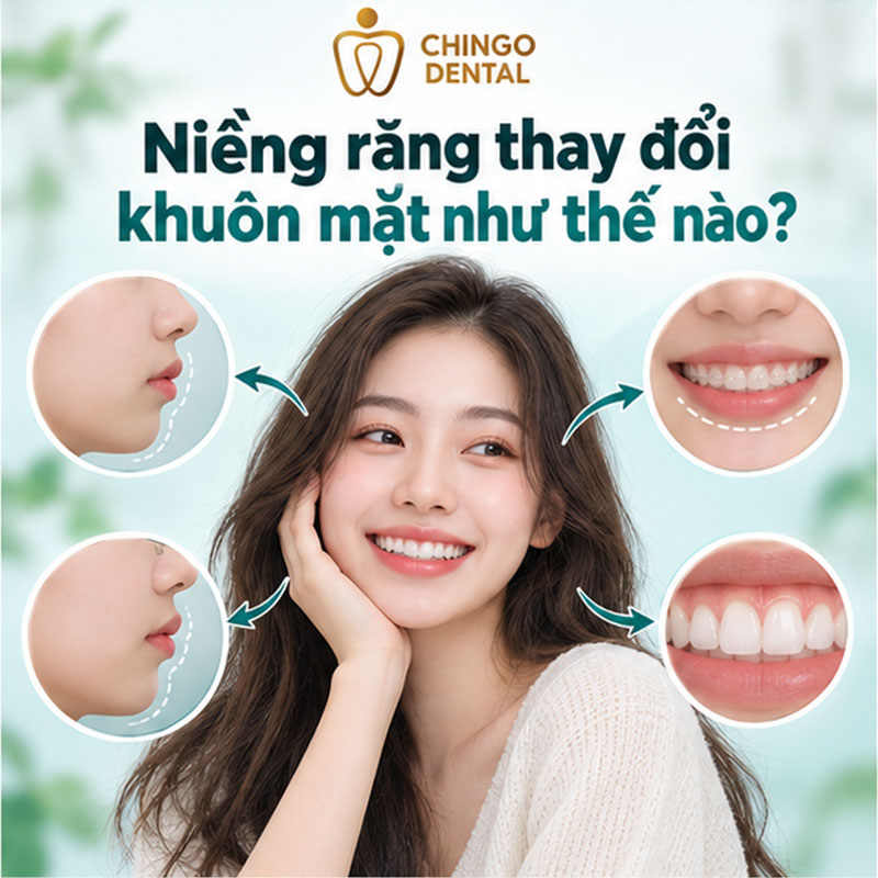 Quá Trình Thay Đổi Khi Niềng Răng: Hành Trình Từ Trước Và Sau Mà Bạn Cần Biết 8 niềng răng có làm thay đổi khuôn mặt
