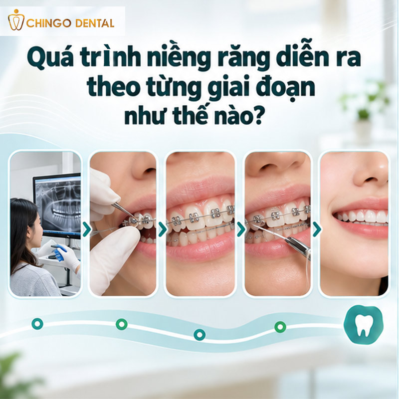 Niềng Răng Nhanh Mất Bao Lâu? Lộ Trình Thực Tế Từ Gắn Mắc Cài Đến Ngày Tháo Niềng 3 niềng răng mất bao lâu