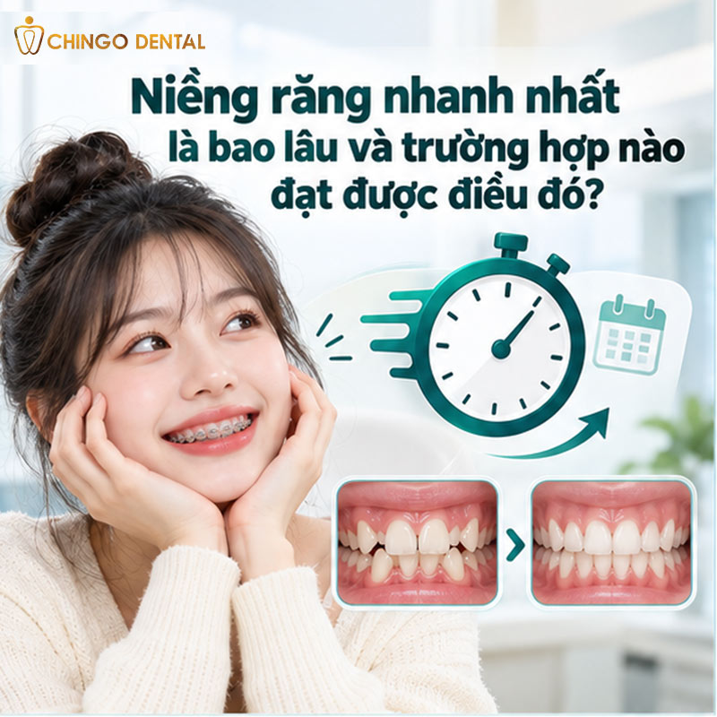 Niềng Răng Nhanh Mất Bao Lâu? Lộ Trình Thực Tế Từ Gắn Mắc Cài Đến Ngày Tháo Niềng 1 niềng răng nhanh
