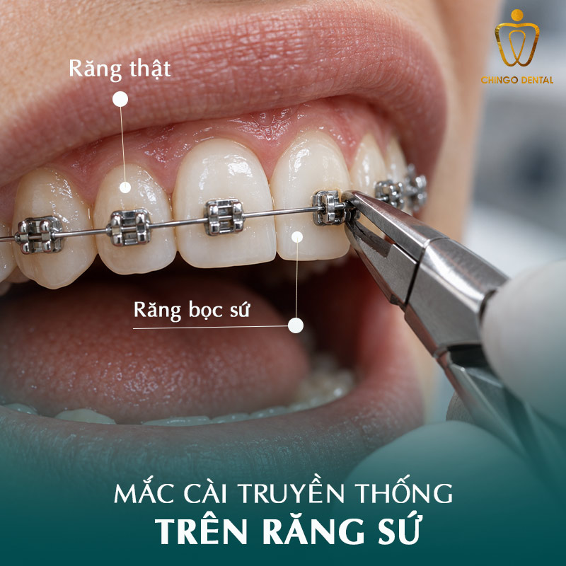Răng Sứ Có Niềng Được Không? Giải Đáp Từ Chuyên Gia 5 niềng răng sứ