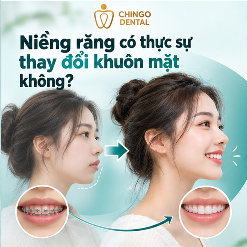 Quá Trình Thay Đổi Khi Niềng Răng: Hành Trình Từ Trước Và Sau Mà Bạn Cần Biết 1 niềng răng trước và sau
