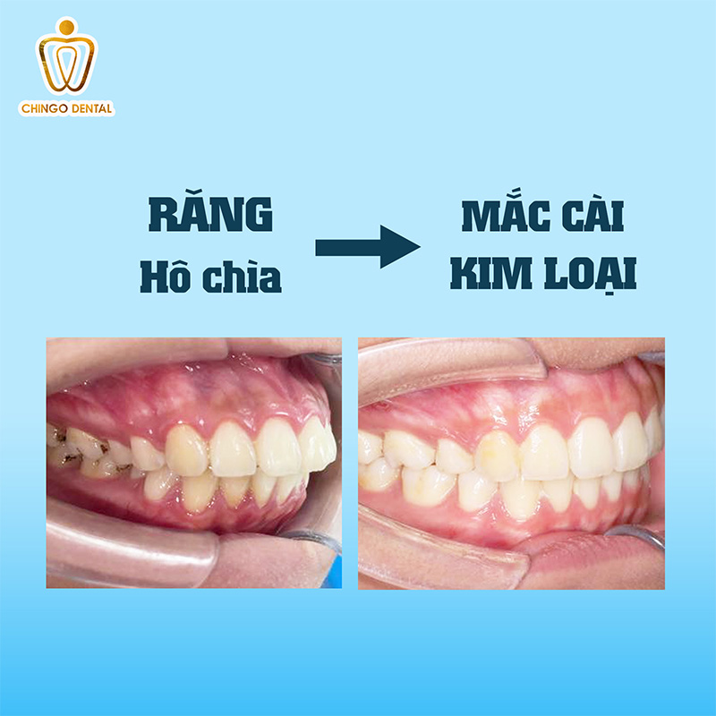 Quá Trình Thay Đổi Khi Niềng Răng: Hành Trình Từ Trước Và Sau Mà Bạn Cần Biết 4 quá trình thay đổi khi niềng răng