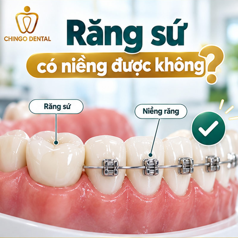 Răng Sứ Có Niềng Được Không? Giải Đáp Từ Chuyên Gia 2 răng sứ có niềng được không