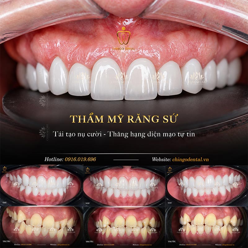 Răng Sứ Zirconia Là Gì? Phân Loại, Ưu Nhược Điểm & Bảng Giá Tham Khảo 4 răng sứ zirconia có mấy loại
