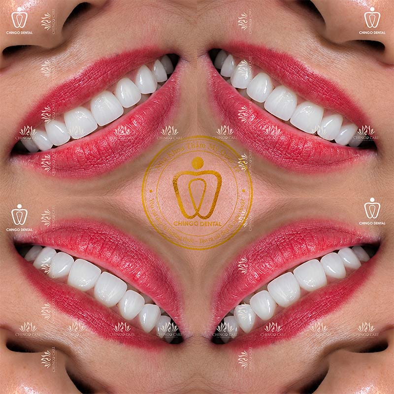 Răng Sứ Zirconia Là Gì? Phân Loại, Ưu Nhược Điểm & Bảng Giá Tham Khảo 5 răng sứ zirconia