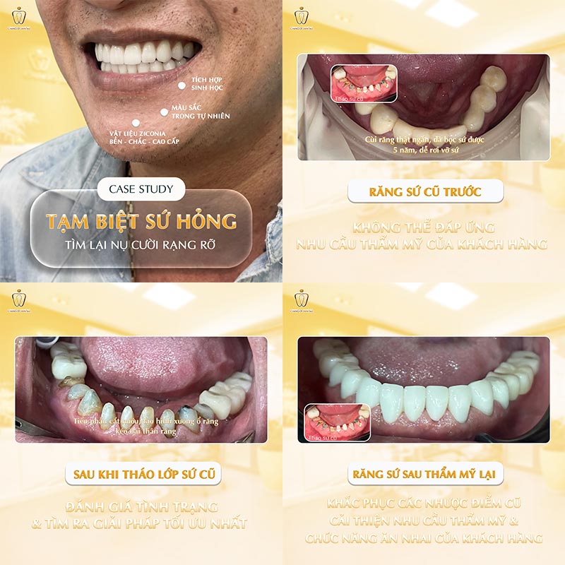 Các Loại Răng Sứ Hiện Nay: Phân Loại, So Sánh và Cách Chọn Đúng Nhất 4 răng toàn sứ có mấy loại