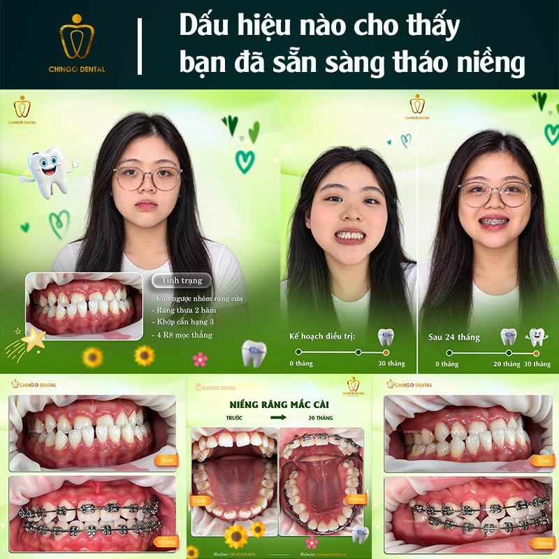 Tháo Niềng Răng – Những Điều Bạn Cần Biết Trước Khi Kết Thúc Hành Trình 2 tháo niềng răng