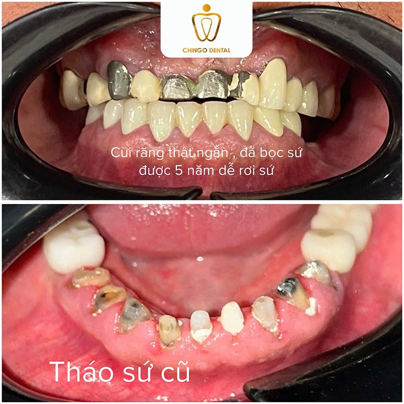 Bọc Răng Sứ Có Tháo Ra Được Không? Bác Sĩ Giải Đáp Toàn Diện 4 tháo răng sứ có đau không