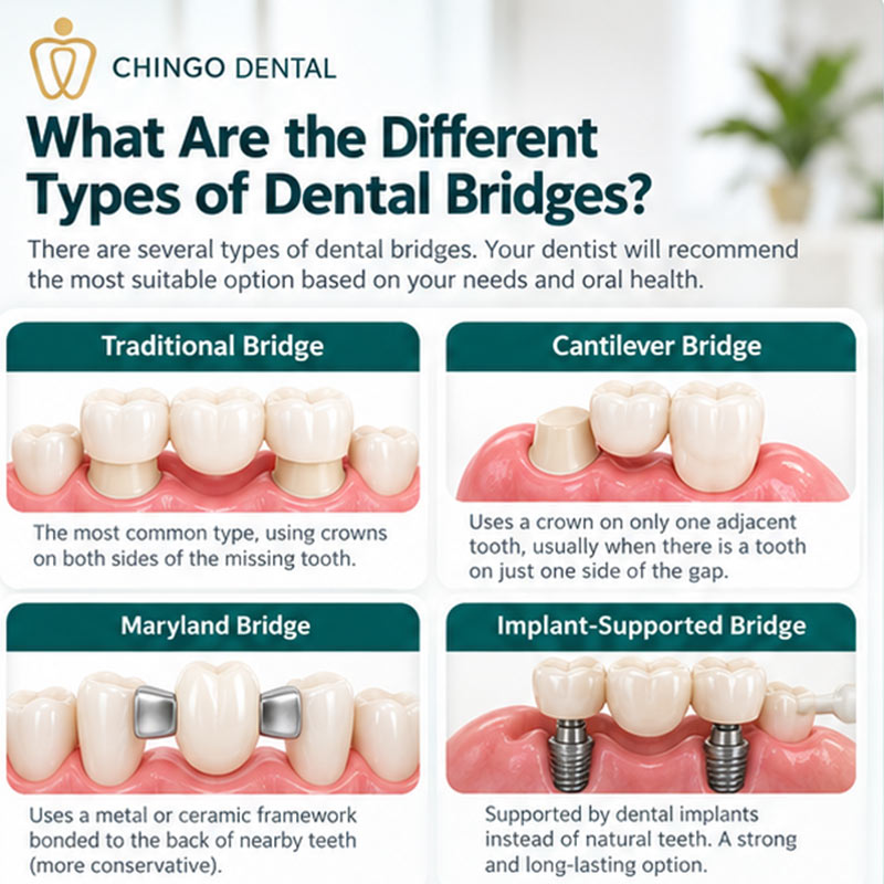 Dental Bridge: Your Complete Guide to Replacing Missing Teeth 3 tooth bridge