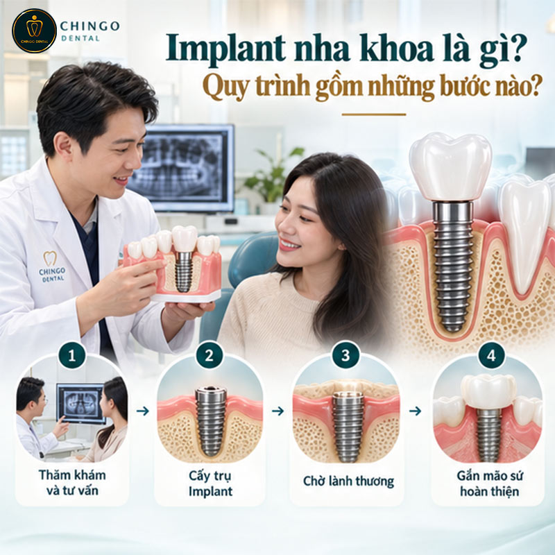 Trồng Răng Implant Có Đau Không? Giải Đáp Toàn Diện Từ A - Z 1 trồng răng implant có đau không